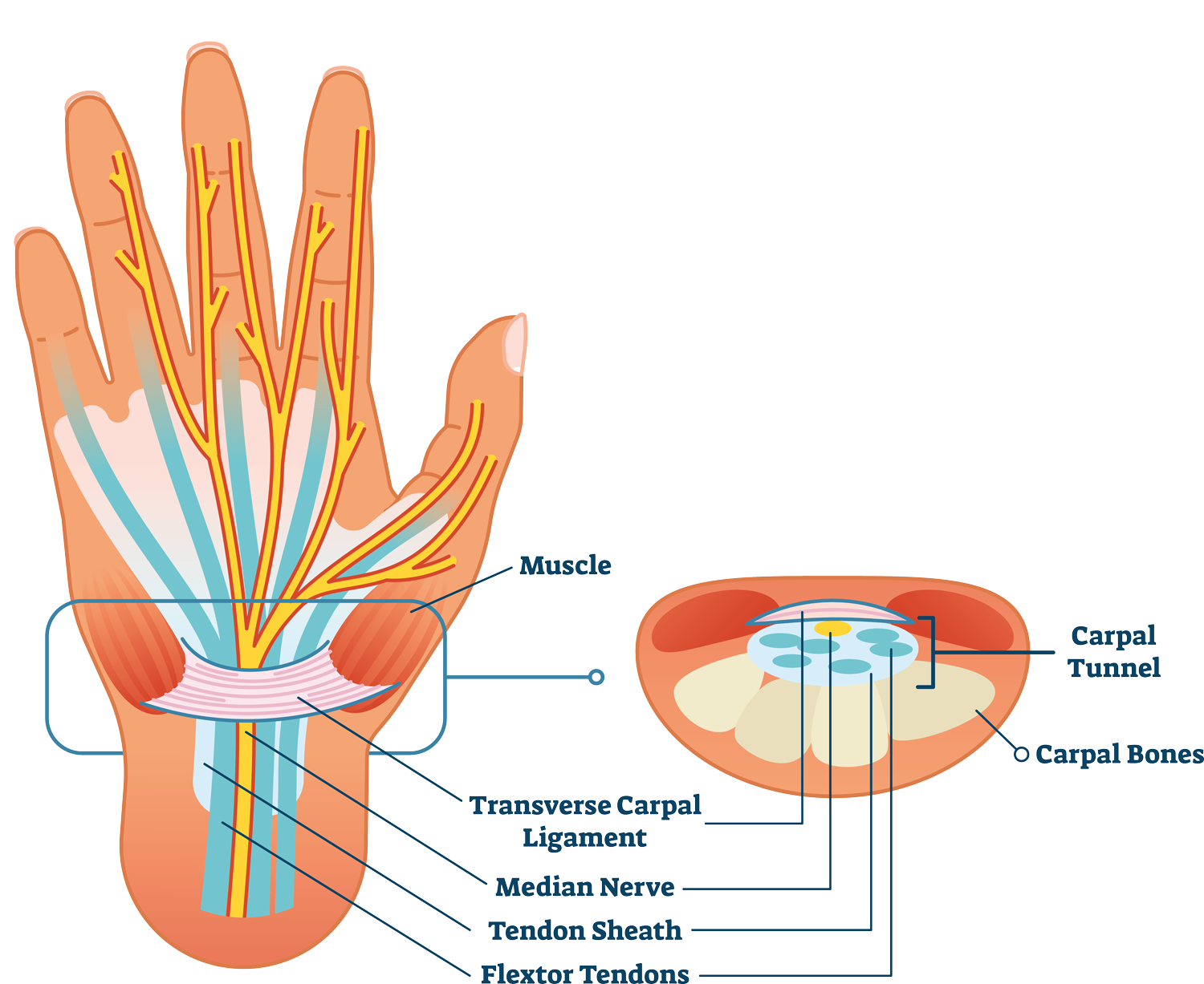 karpaltunnel-1006876360