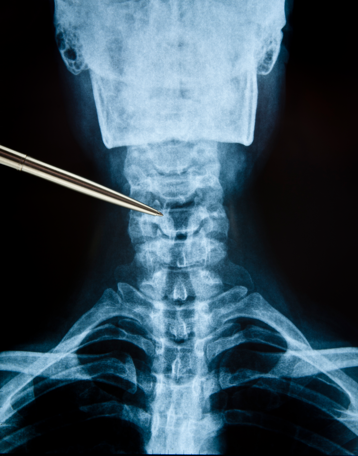 Röntgenaufnahme der Wirbelsäule